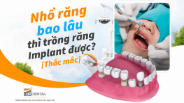 Nhổ răng bao lâu thì trồng răng Implant được? [Thắc mắc]