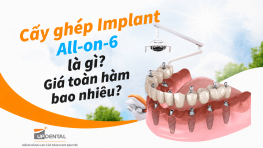 Cấy ghép Implant all-on-6 là gì? Giá toàn hàm bao nhiêu