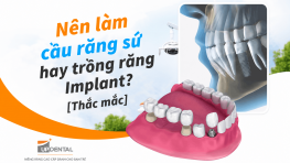 Nên làm cầu răng sứ hay trồng răng Implant? [Thắc mắc]
