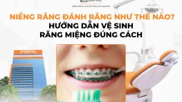 Niềng răng đánh răng như thế nào? Hướng dẫn vệ sinh răng miệng đúng cách