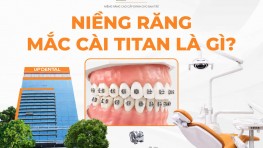 Niềng răng mắc cài Titan là gì? Giá bao nhiêu?