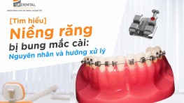 [Tìm hiểu] Niềng răng bị bung mắc cài: Nguyên nhân và hướng xử lý