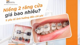 Giá niềng 2 răng cửa bao nhiêu? 5 yếu tố ảnh hưởng đến chi phí