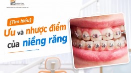 [Tìm hiểu] Ưu và nhược điểm của niềng răng