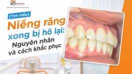 [Tìm hiểu] Niềng răng xong bị hô lại: Nguyên nhân và cách khắc phục