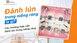 Đánh lún trong niềng răng là gì? Các trường hợp cần đánh lún