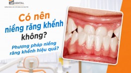 Có nên niềng răng khểnh không? Phương pháp niềng khểnh hiệu quả