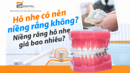 Hô nhẹ có nên niềng răng không? Niềng răng hô nhẹ giá bao nhiêu?